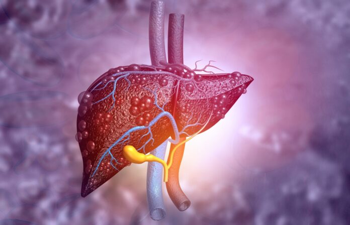 Fatty Liver Disease, A Diabetes Complication, Deserves More Attention