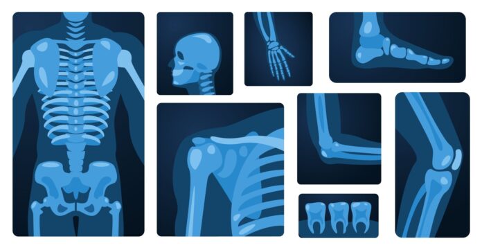 Bone Health and Diabetes: What You Need To Know