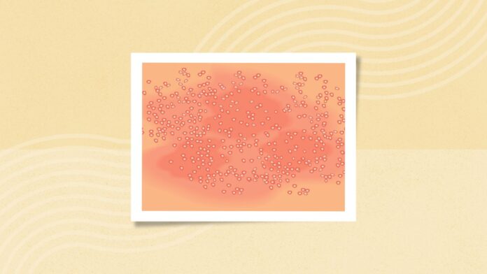 What Is Generalized Pustular Psoriasis (GPP)? Symptoms, Causes, Diagnosis, Treatment, and Prevention