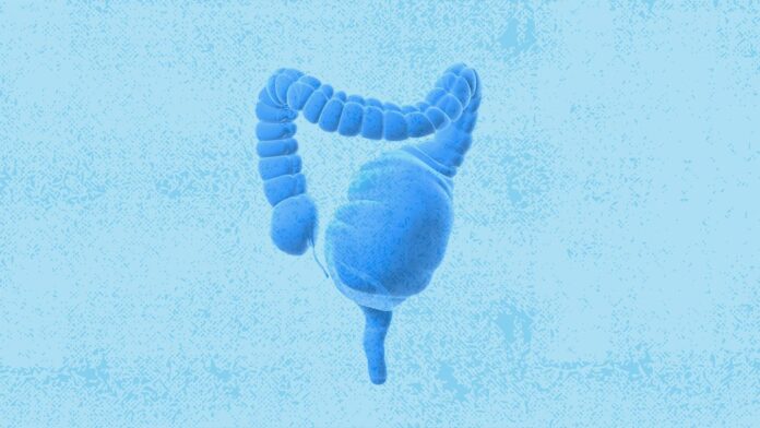 What Is Toxic Megacolon?