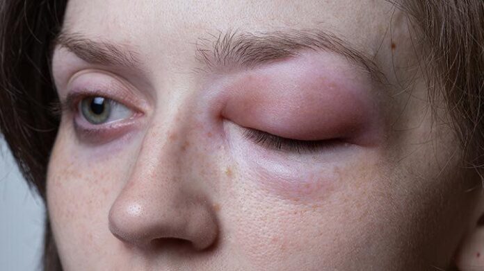Hereditary Angioedema Symptoms